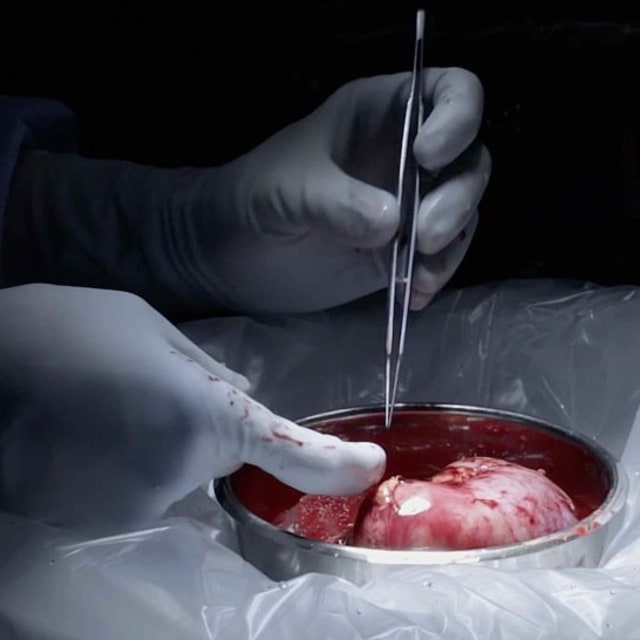 Hidup dengan 1 Ginjal Itu seperti Apa?